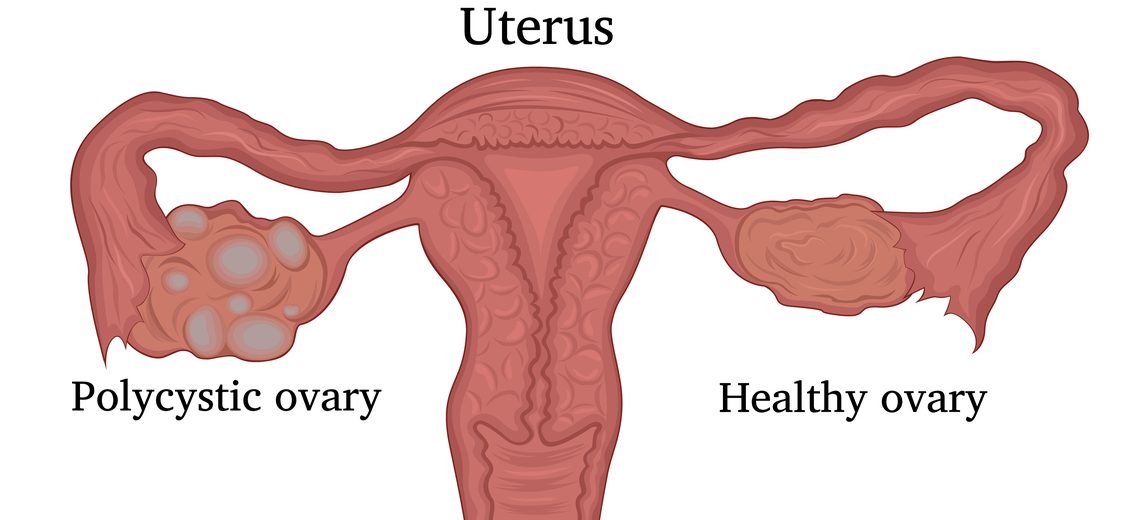 Why Women with PCOS (Polycystic Ovarian Syndrome) Are at Higher Risk of Obesity