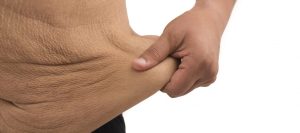Can Loose Skin from Sleeve Bariatric Surgery be Handled Without Plastic Surgery? –  Loose Skin from Sleeve Bariatric Surgery Solutions