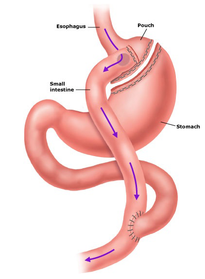 Roux-en-Y Gastric Bypass