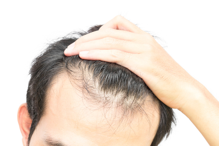 What to Know About Hair Loss From Stress  Keepscom