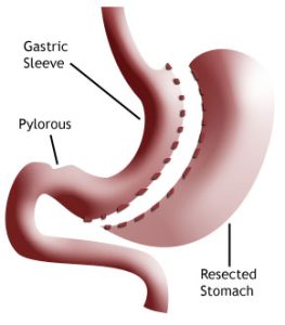 Sleeve Gastrectomy as a Primary Weight Loss Procedure