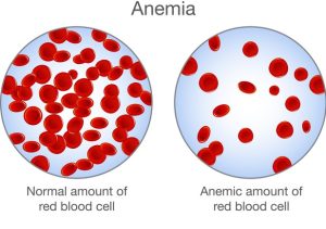 Obesity Increases the Risk of Iron Deficiency Anemia