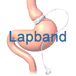 Lapband